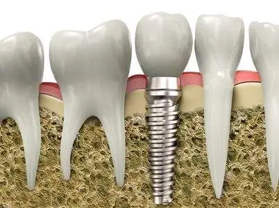 口腔市场暴利链条解构：上万元的牙植体，成本仅几百元