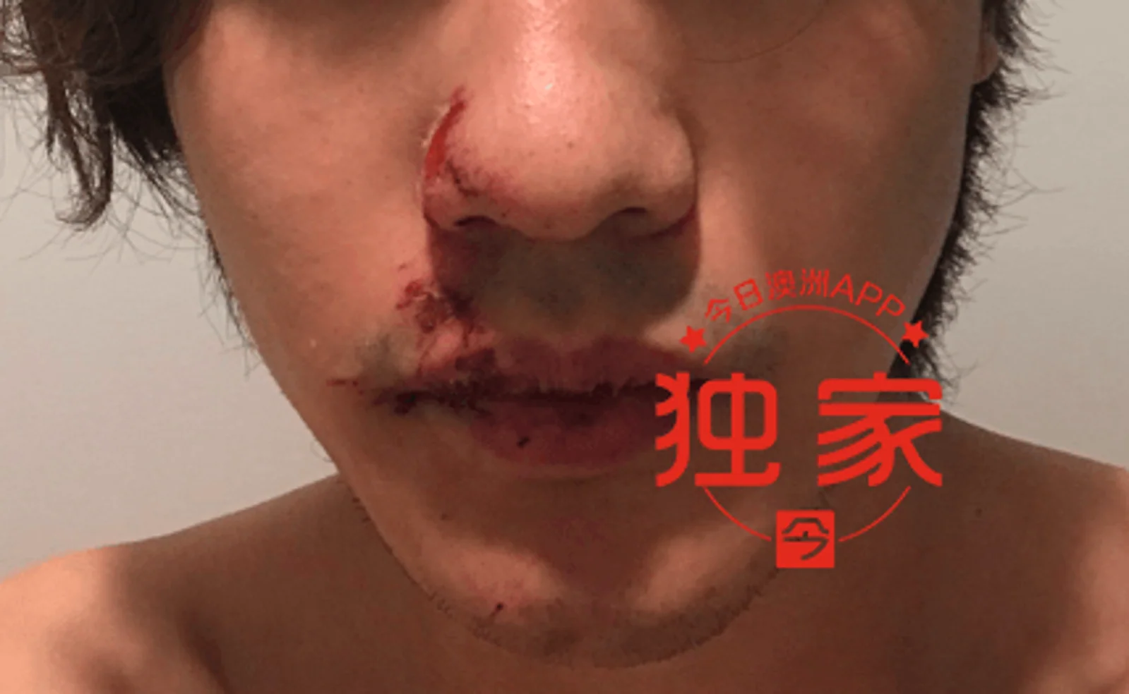 悉尼华男遇车祸，斑马线上撞飞10米！遍体鳞伤牙断裂，“以为我要死了！”