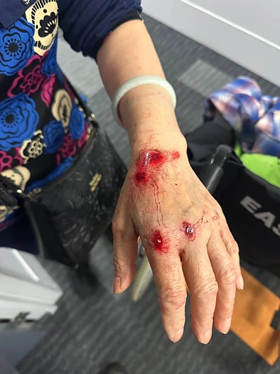 气愤！奥克兰祖孙二人坐公交险丧命，司机一个操作致其重伤，很多人都遇到过！