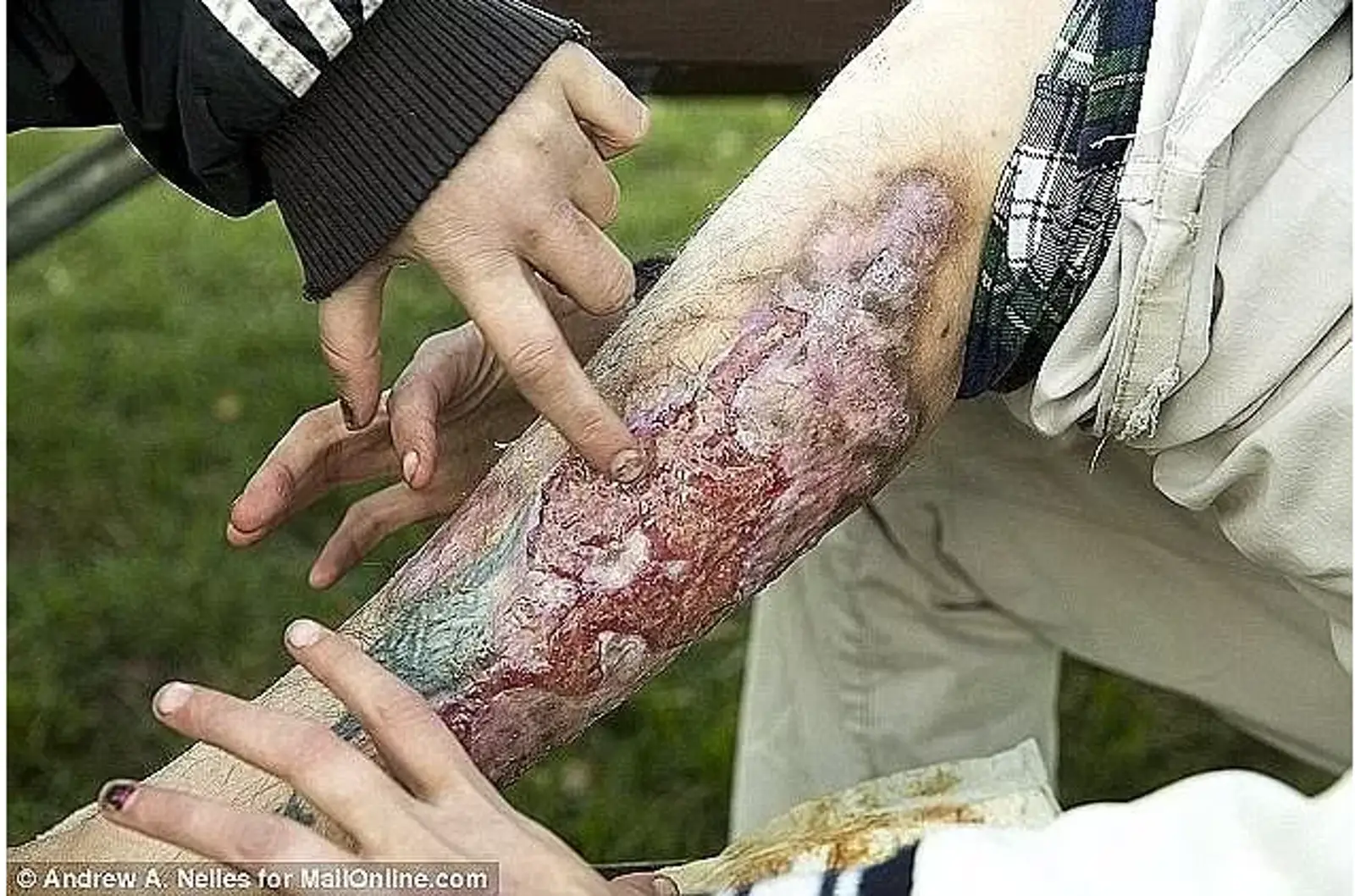 紧急警告！恐怖食肉菌毒品入侵澳洲，华人小心！碰到了会变成这恐怖样子！