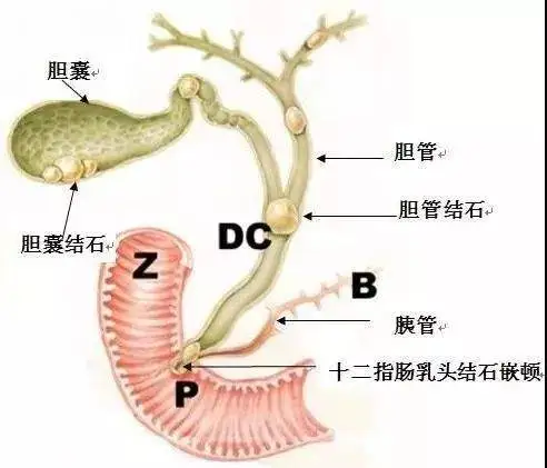 果汁和油喝下去，颗颗“结石”拉出来，这么做真能排结石？