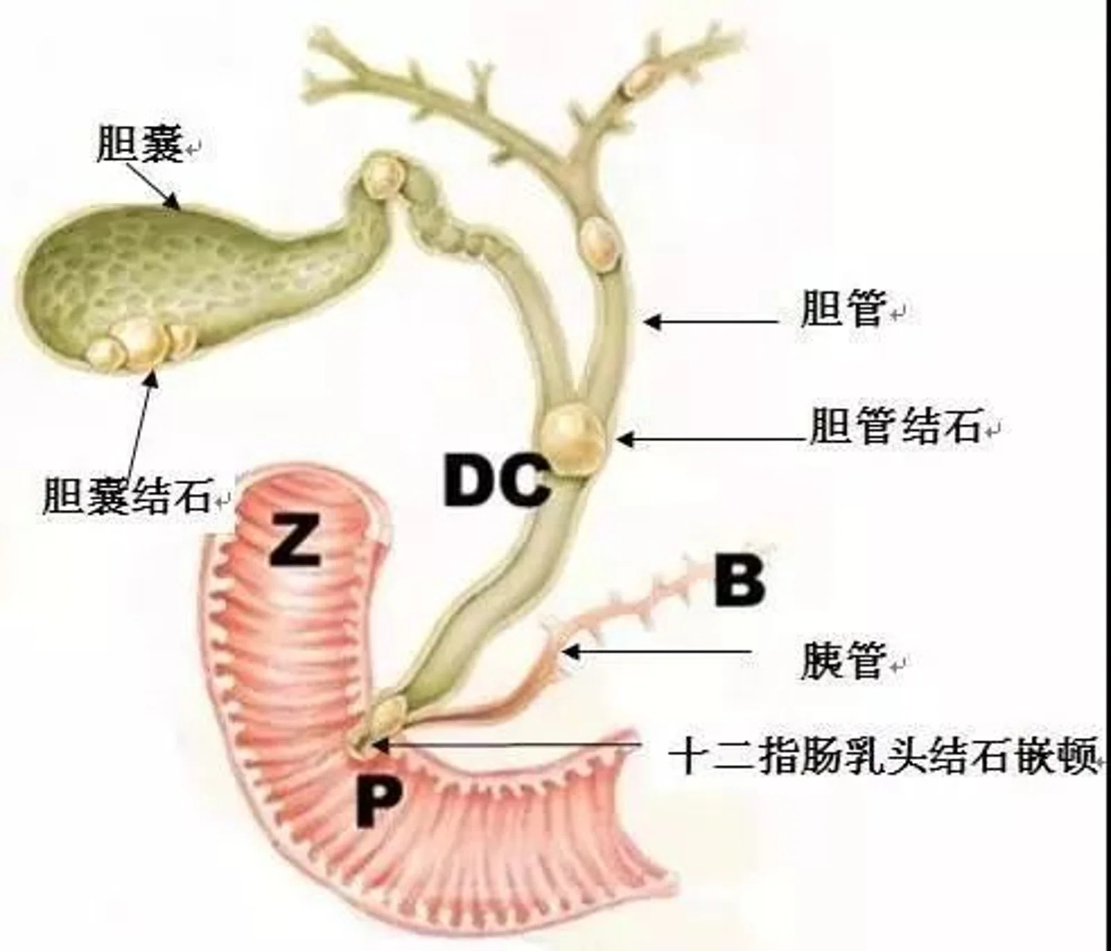 果汁和油喝下去,颗颗“结石”拉出来,这么做真能排结石?