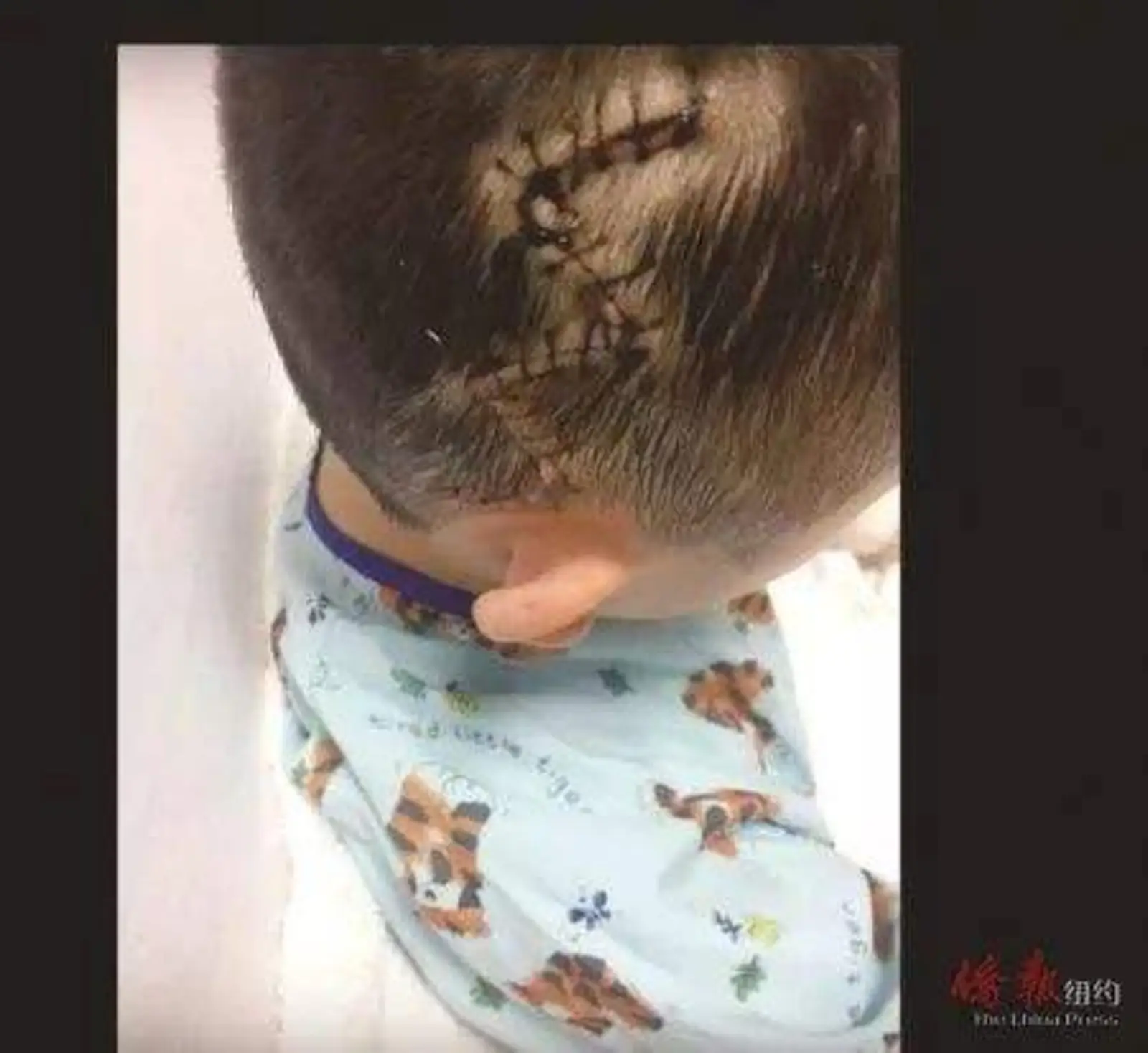 华童校内摔伤脑骨裂失忆！家长伤心欲绝求事故原因，校方沉默无解释…孩子的上学安全还有保障吗？