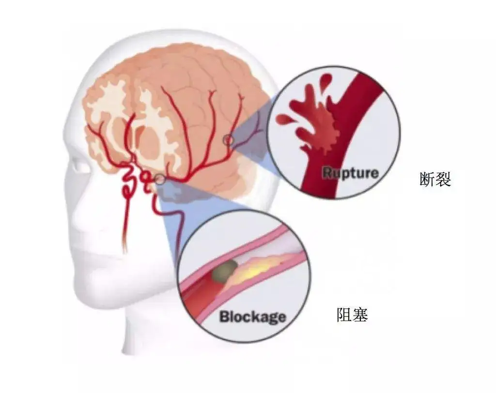 中国人中风可能性全球第一，中国男性中风风险超40%！年轻人也要开始堤防这一疾病问题了